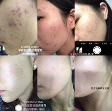 Load image into Gallery viewer, SHERO CHING - HARMONY CREAM (PIMPLE CREAM)
